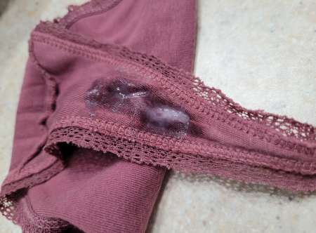 String sales et plein de sécrétions vaginales